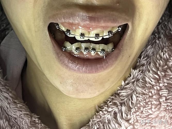 成都牙齿正畸医院怎么选？效果、费用、医生要注意啥？-图1