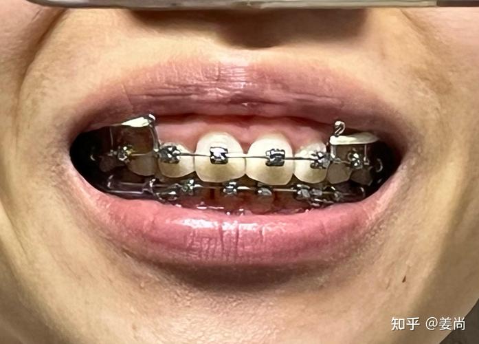 成都牙齿正畸医院怎么选？效果、费用、医生要注意啥？-图2