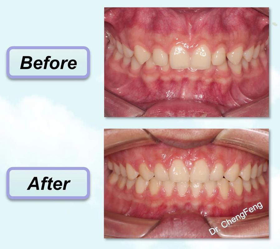 正畸调整咬合，究竟对牙齿功能有何关键作用？-图1