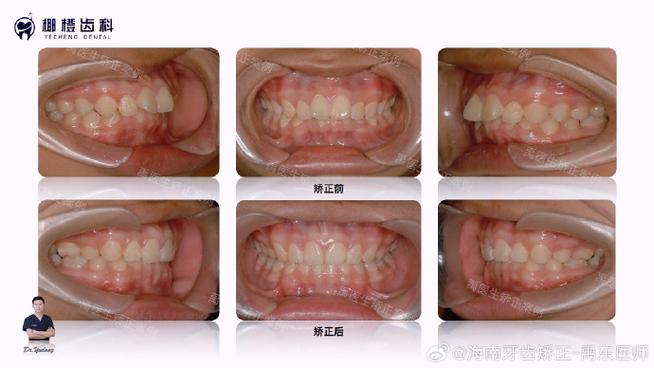正畸调整咬合，究竟对牙齿功能有何关键作用？-图3