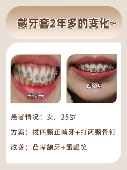 牙齿正畸要带多久-图1 牙齿正畸要带多久-图1