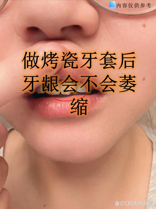 烤瓷牙还能正畸吗-图1