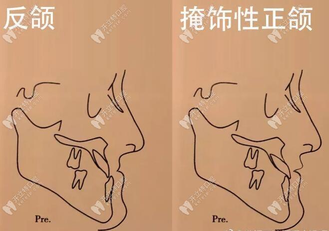 掩饰性正畸 正颌-图1