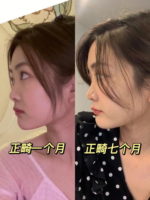 掩饰性正畸 正颌-图2