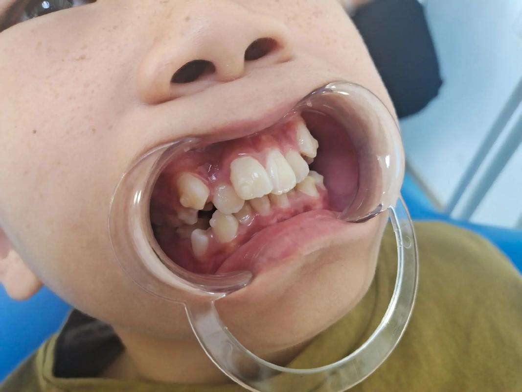 北京 正畸 隐形-图3