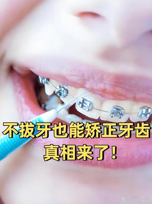 不拔牙正畸可以吗-图1 不拔牙正畸可以吗-图1