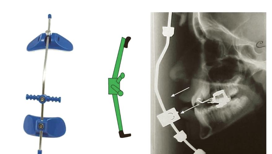 正畸前方牵引力值-图3