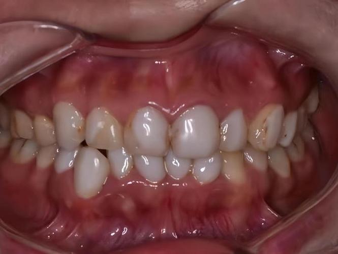 牙正畸失败后遗症-图1