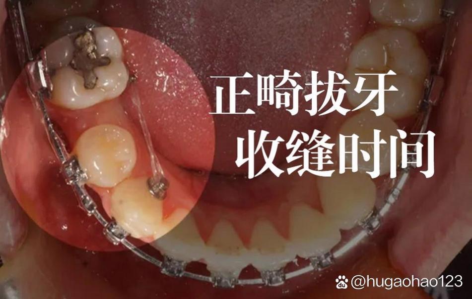 正畸拔牙收缝怎么收？图解步骤全解析，方法在这？-图1