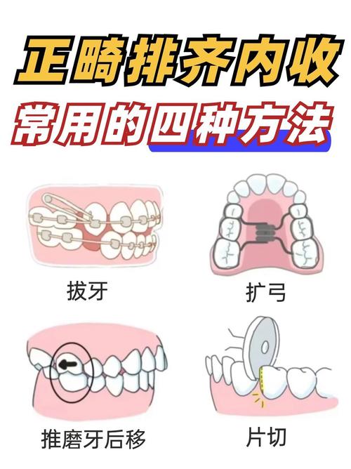 正畸内收前牙的原理是什么？其力学与生物学机制如何？-图3
