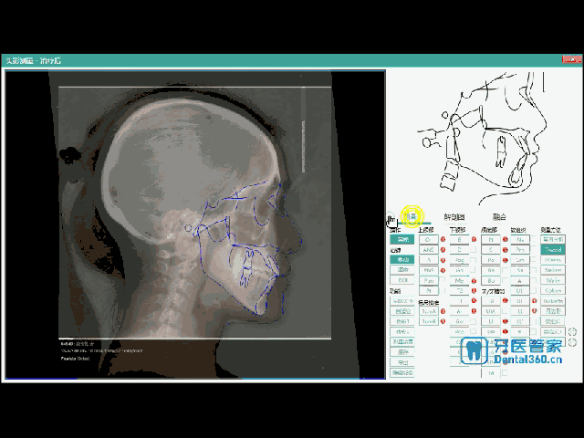 口腔正畸投影测量-图3 口腔正畸投影测量-图3