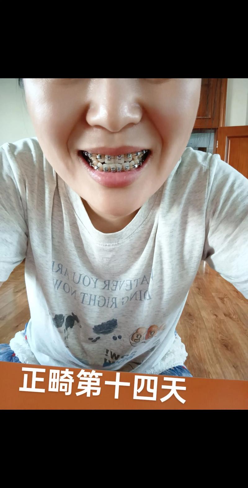 第一篇正畸博客-图1