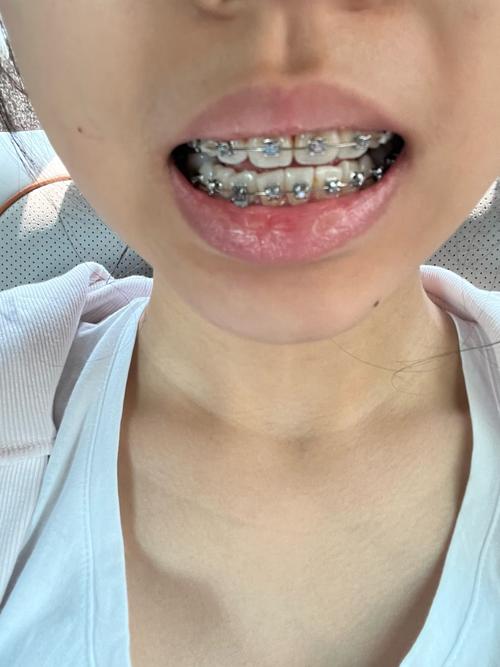 正畸牙齿第一天-图1 正畸牙齿第一天-图1