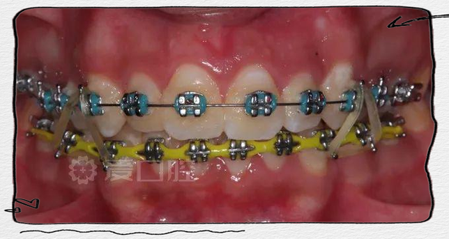 正畸弓丝往一侧-图1