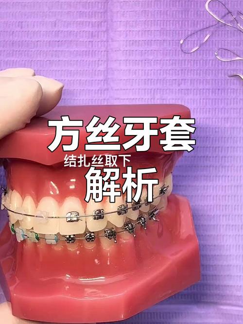 正畸弓丝往一侧-图2