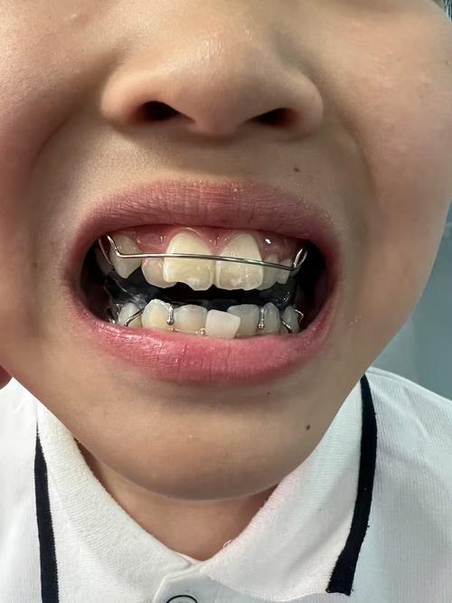 用弓丝扩弓正畸-图1 用弓丝扩弓正畸-图1