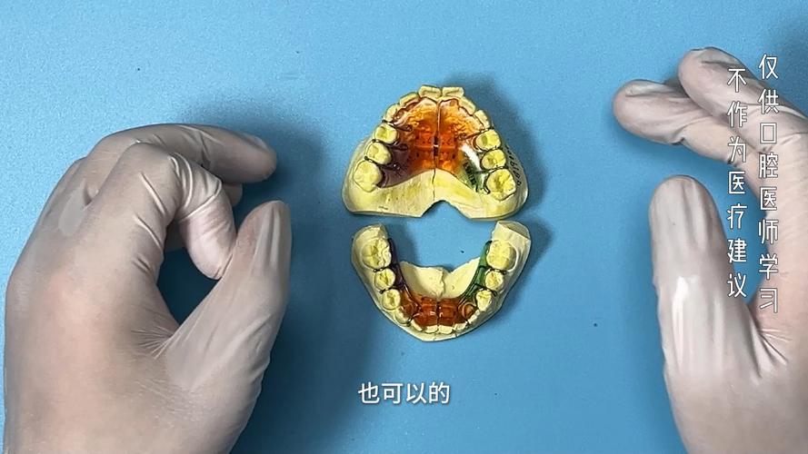用弓丝扩弓正畸-图3 用弓丝扩弓正畸-图3