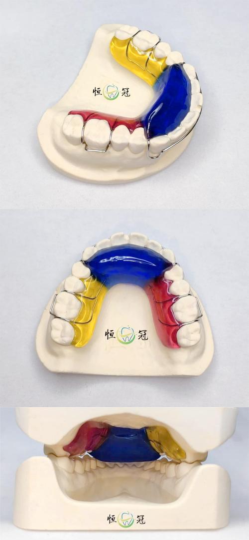 正畸固定式平导-图2