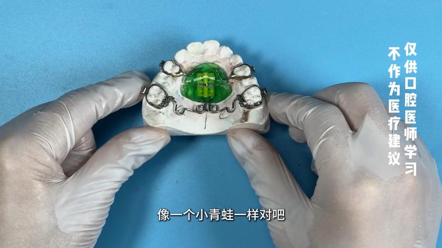 正畸摆氏矫治器-图1 正畸摆氏矫治器-图1