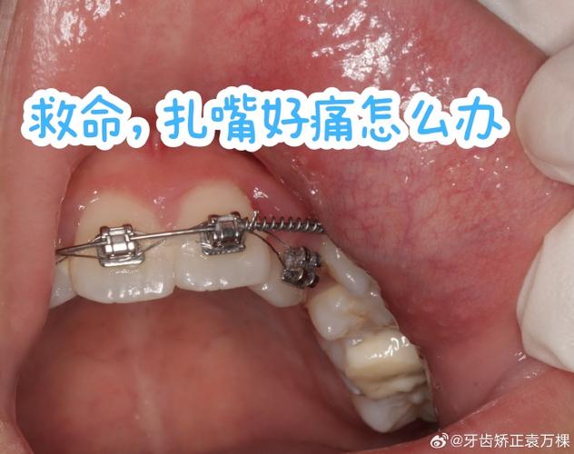 正畸牵引钩扎嘴-图3 正畸牵引钩扎嘴-图3