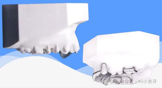 正畸斜导多少钱?价格受哪些因素影响?-图3 正畸斜导多少钱?价格受哪些因素影响?-图3