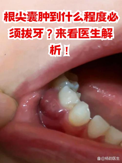 正畸控根后牙肉疼,是正常现象吗?-图1 正畸控根后牙肉疼,是正常现象吗?-图1