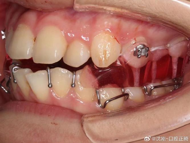 S8正畸是什么-图3