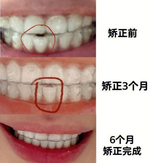隐适美开颌正畸-图2
