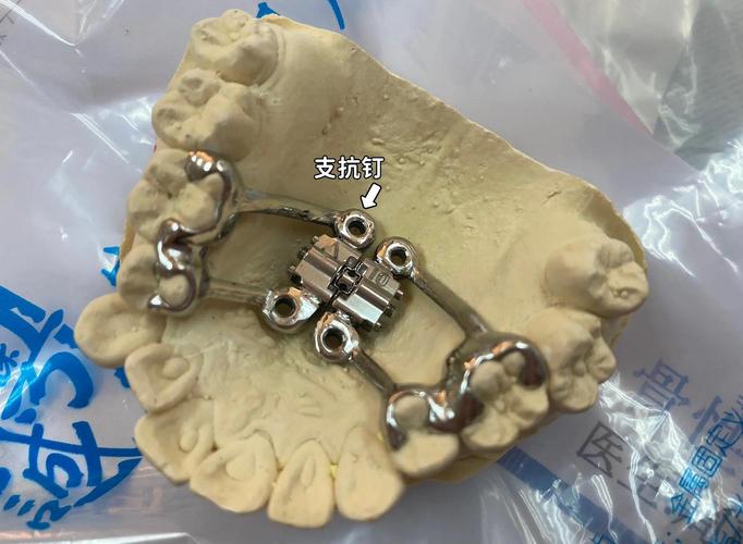 正畸辅弓管扩弓-图1 正畸辅弓管扩弓-图1
