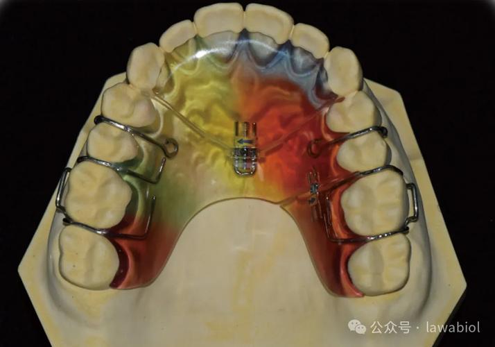 正畸辅弓管扩弓-图2 正畸辅弓管扩弓-图2