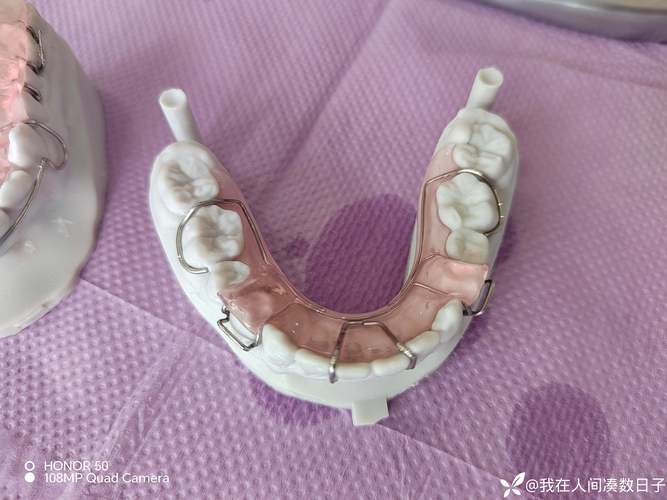 正畸t型曲弯制-图2