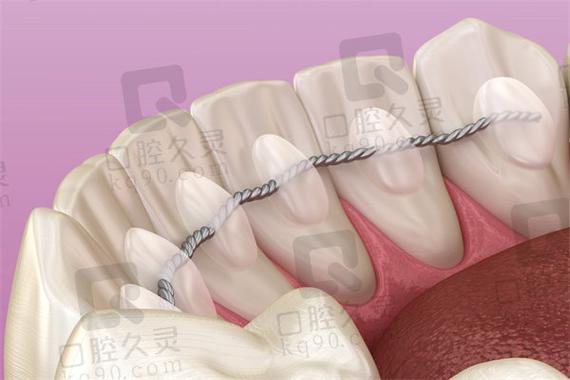 正畸八字结扎图-图1