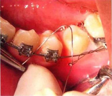 正畸八字结扎图-图2