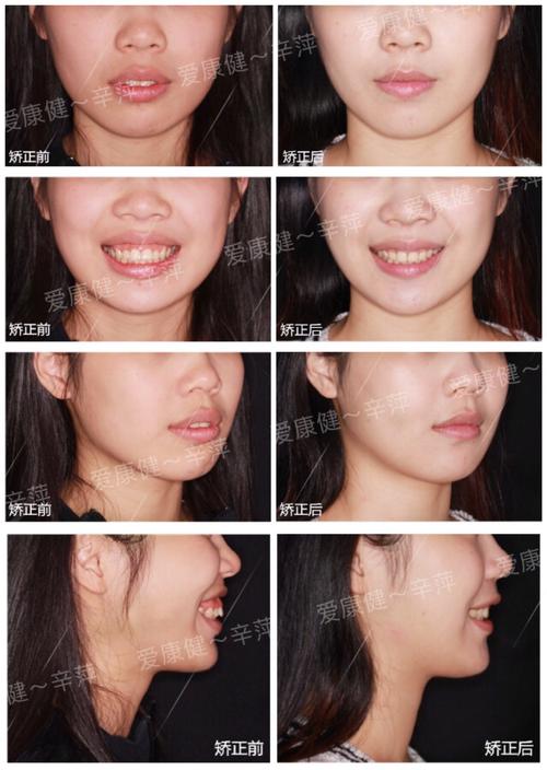 正畸整成露龈笑-图3