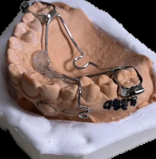 可摘牵引钩正畸-图1 可摘牵引钩正畸-图1