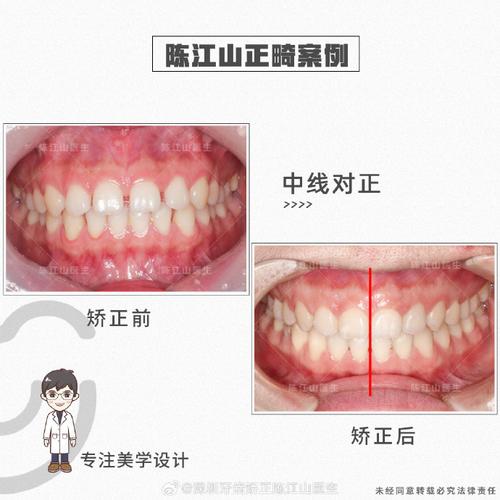 骨性露龈笑正畸矫正效果如何？-图2