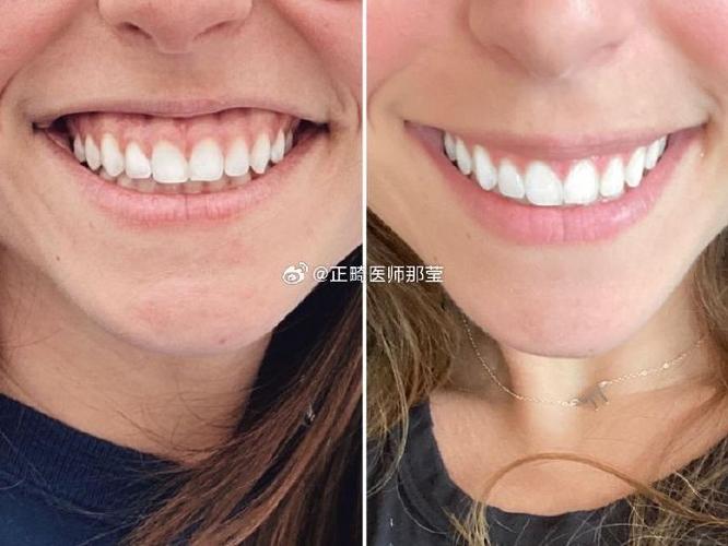 骨性露龈笑正畸矫正效果如何？-图3