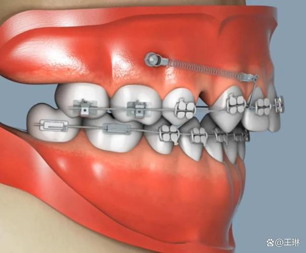 二次正畸打支抗-图2