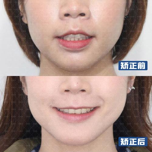 正畸后上牙前突-图3