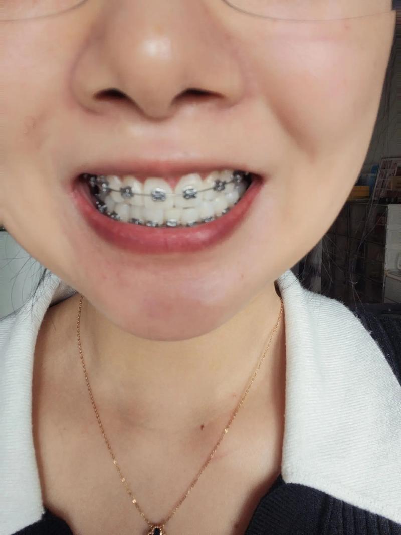 正畸牙弓变窄了-图2