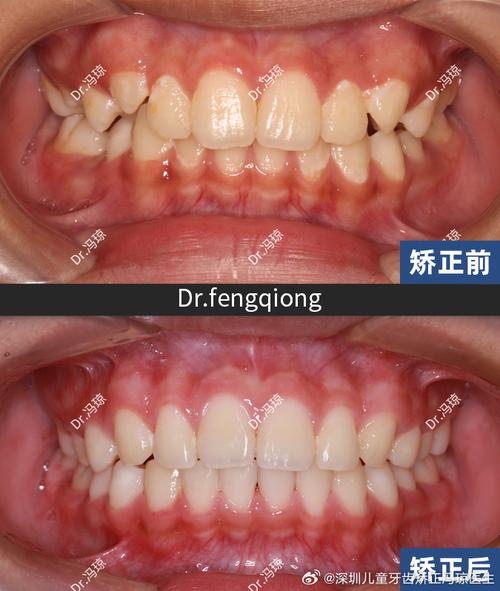 正畸牙弓变窄了-图3