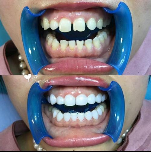 正畸后做牙贴面-图1