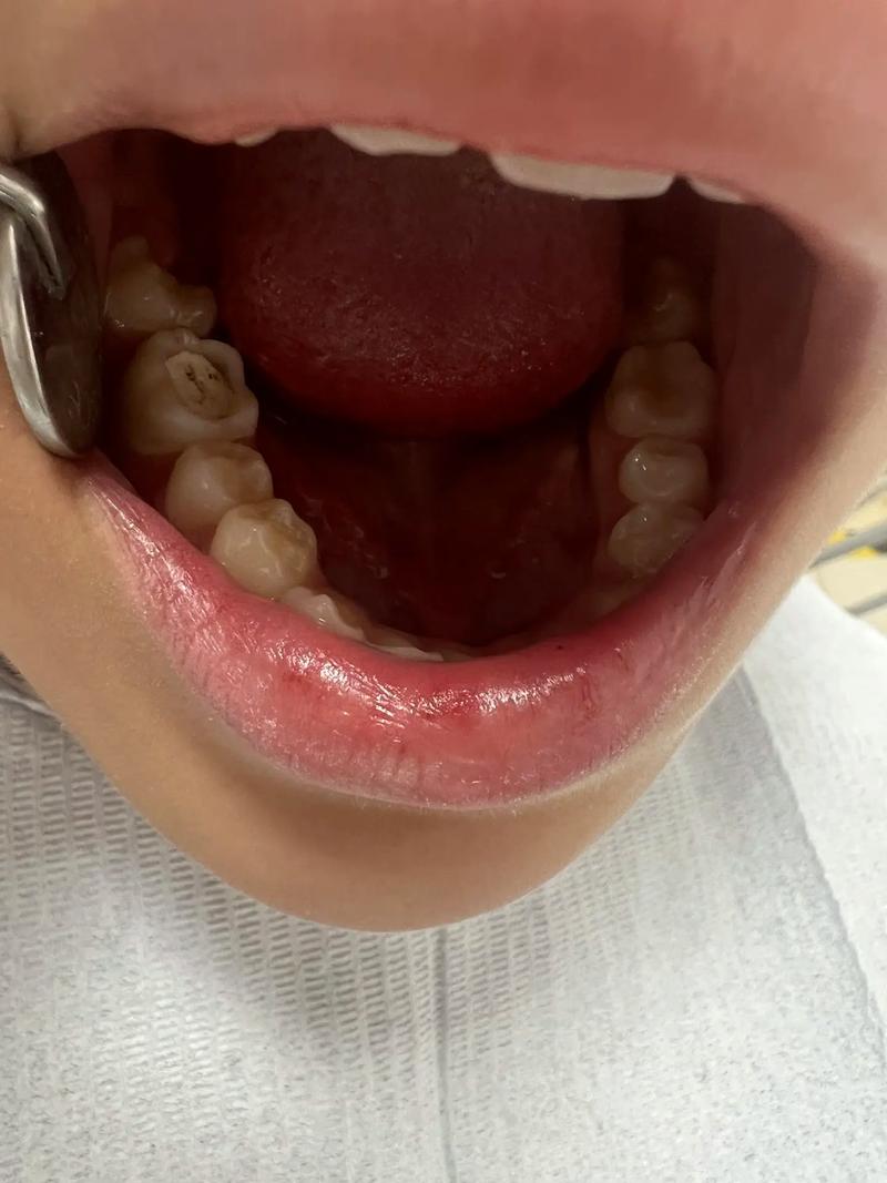 正畸后做牙贴面-图2