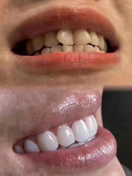 正畸后做牙贴面-图3