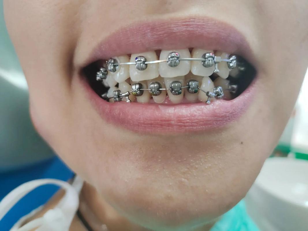 双弓丝正畸托槽-图2