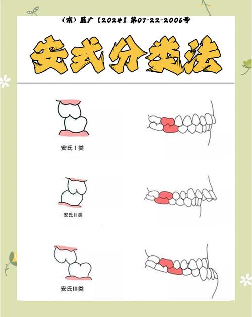 安氏III类错颌正畸矫正的关键难点是什么？-图1