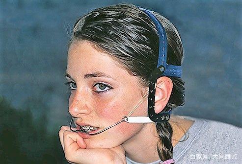 正畸J钩的戴法-图1