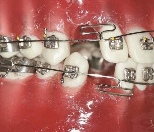 正畸菱形簧弯制-图3