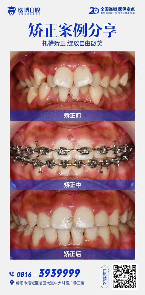 正畸后面前面高比会有哪些变化？-图1