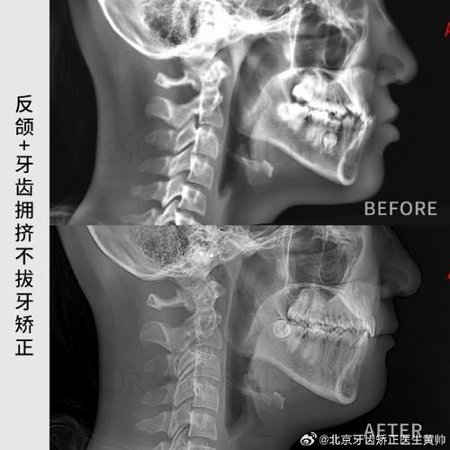 正畸侧位片是什么？为何正畸诊断离不开它？如何解读？-图2